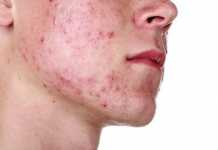 Remedios naturales para tratar el acné quístico acne