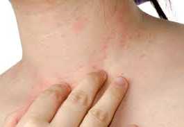 alergia