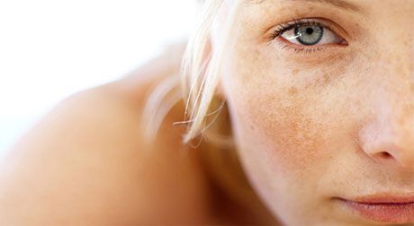 melasma