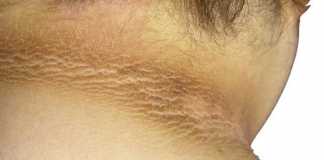 acantosis