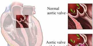 endocarditis