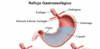 esofagitis