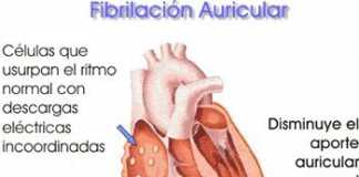 fibrilacion_auricular