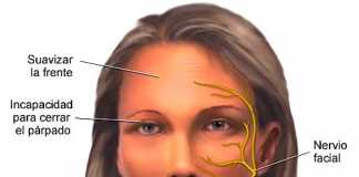 paralisisfacial