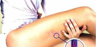 varices1