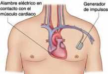 Recomendaciones en el caso de llevar un marcapasos marca-pasos