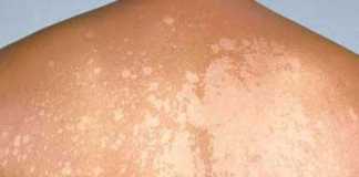 pitiriasis-versicolor