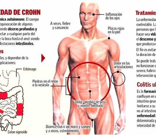 Enfermedad de Crohn, más cerca de la solución chron