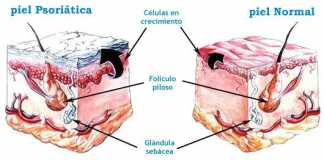 psoriasis