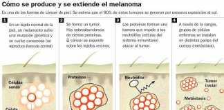 melanoma