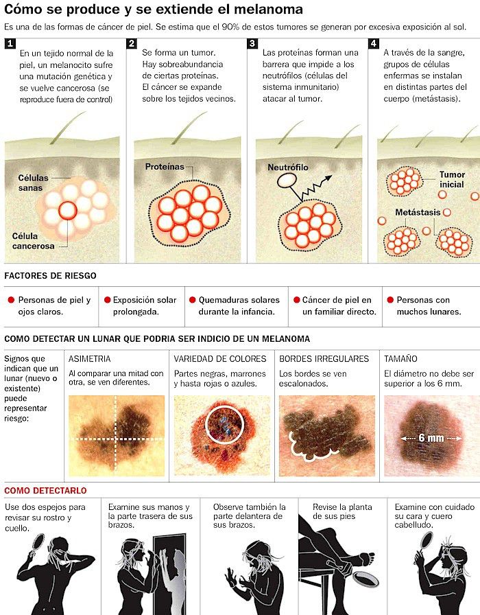 melanoma