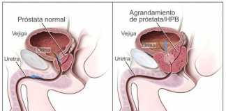 prostata