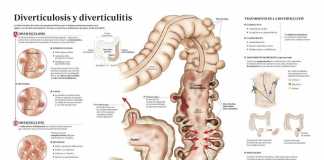 diverticulitis