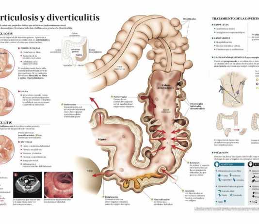 Como tratar la diverticulitis diverticulitis