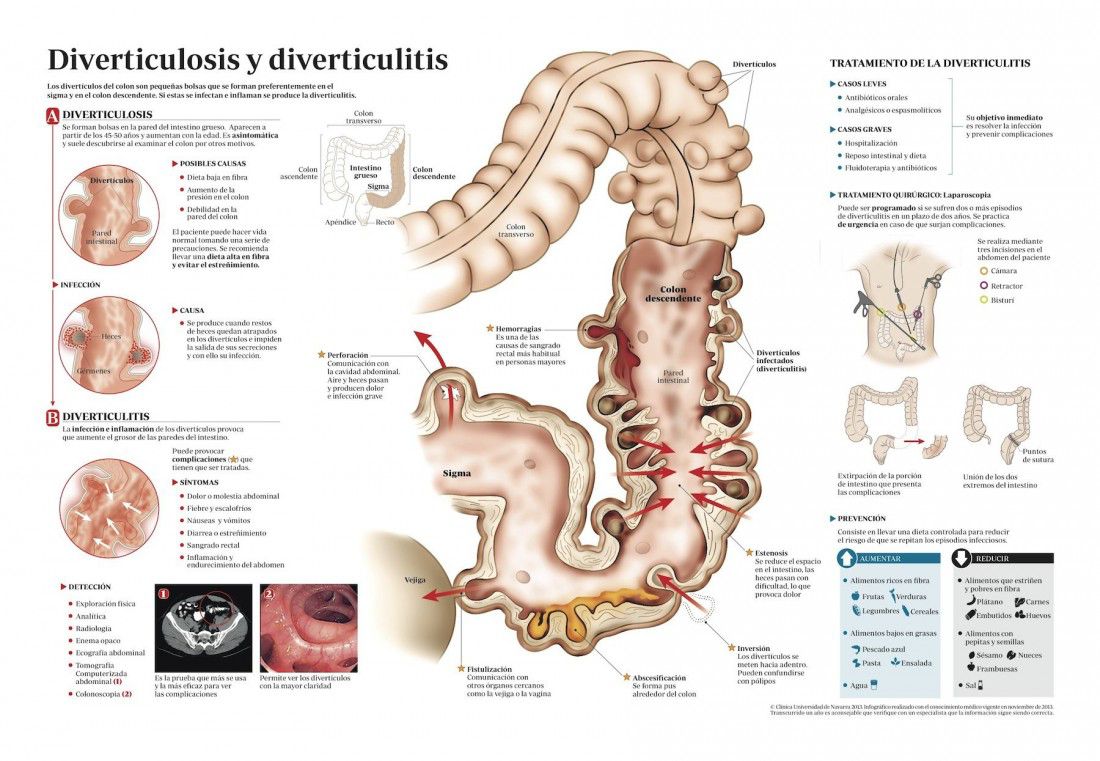 diverticulitis