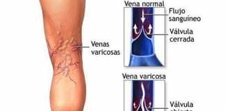 flebitis