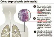 Evitar las enfermedades pulmonares, la bronquitis crónica y el enfisema neumonia
