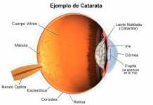 catarataojos