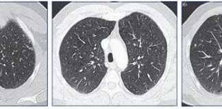 enfisema-tomografia