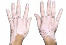 Métodos naturales contra el vitíligo vitiligo