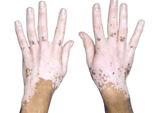 vitiligo