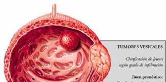 cancervejiga