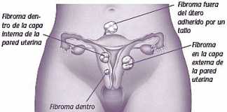fibromas
