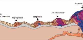 tumor-canceroso