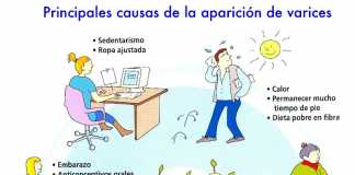 varicosas