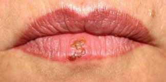 herpes-labios