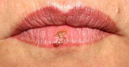 Como combatir el herpes labial herpes-labios