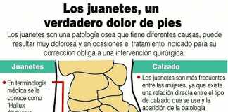 juanetes