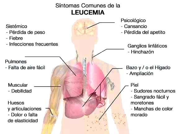 leucemia