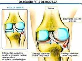 osteoartritis_rodilla