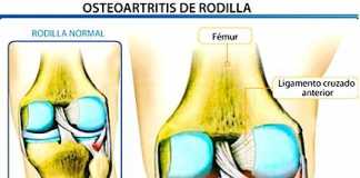osteoartritis_rodilla