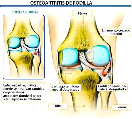osteoartritis_rodilla