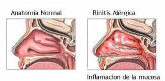 rinitis