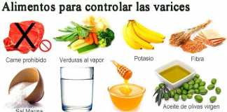 varices