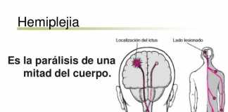 hemiplejia