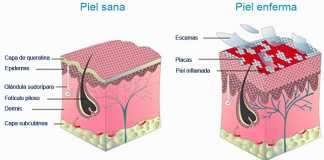 psoriasis