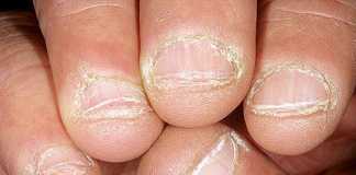 Dermatofagia