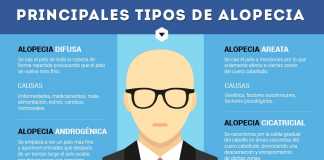 alopecia-difusa