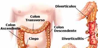 diverticulitis