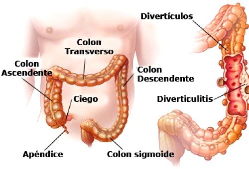 Consejos para prevenir la diverticulitis diverticulitis