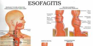 esofagitis1