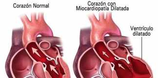 miocardiopatiadilatada