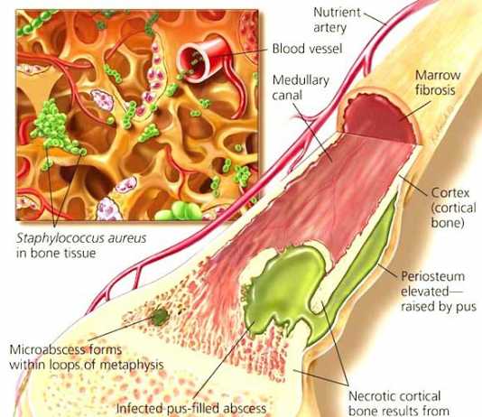 Infecciones de huesos osteomielitis