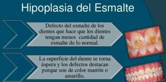 Hipoplasia-dientes