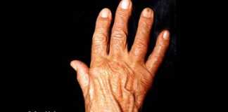 artrosis-pulgar