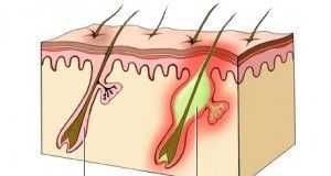 foliculitis